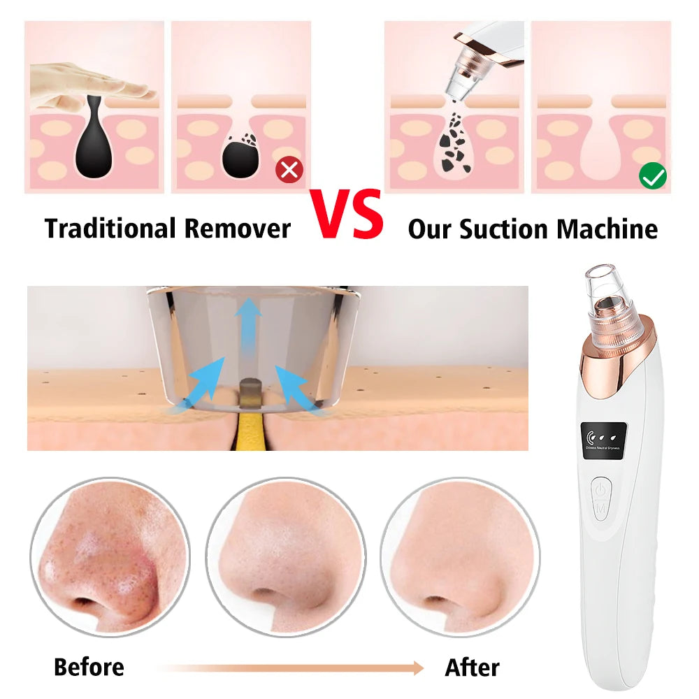 Electric Blackhead Remover Vacuum – Deep Cleansing Facial Pore Cleaner for Acne